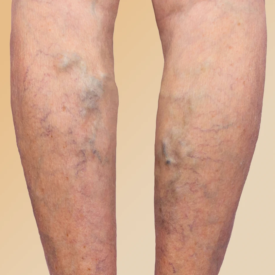 Advanced Varicose Veins Treatment