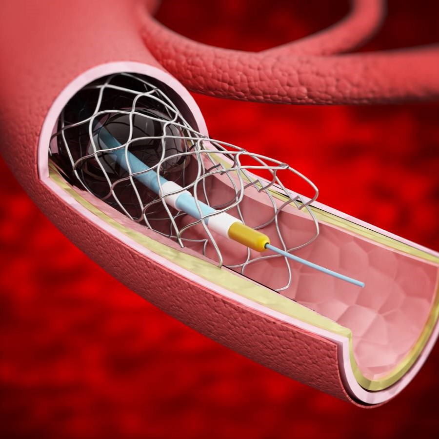 Endovascular Interventions