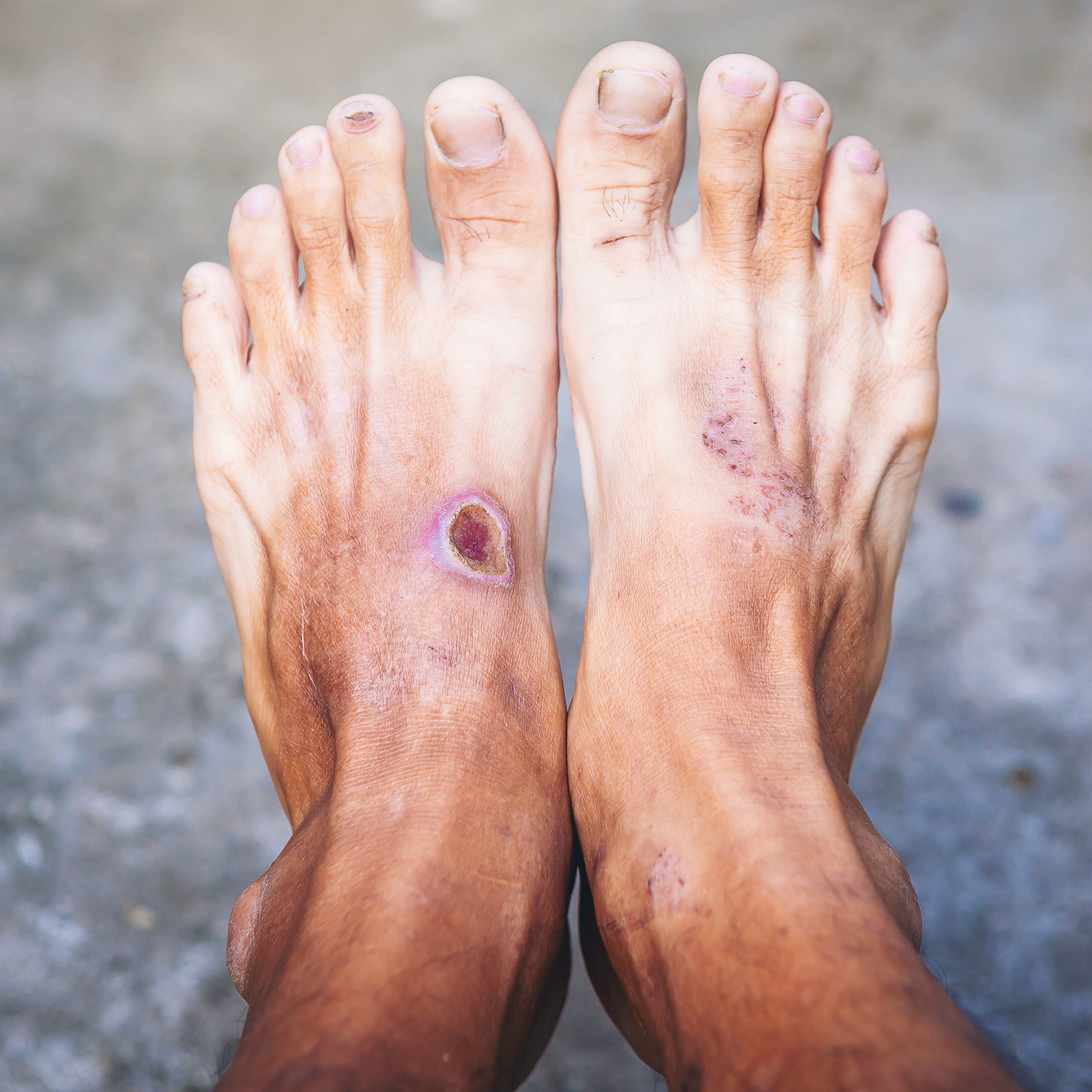 Diabetic Foot Care and Limb Salvage: Protecting Mobility and Preventing Amputations